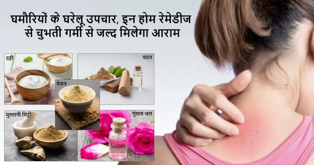 कांटेदार गर्मी के लिए प्राकृतिक 5 घरेलू उपचार